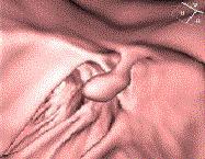 전산화단층촬영 대장내시경에서 발견된 대장 용종