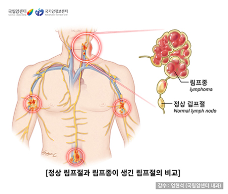 정상림프절과 림프종이 생긴 림프절의 비교