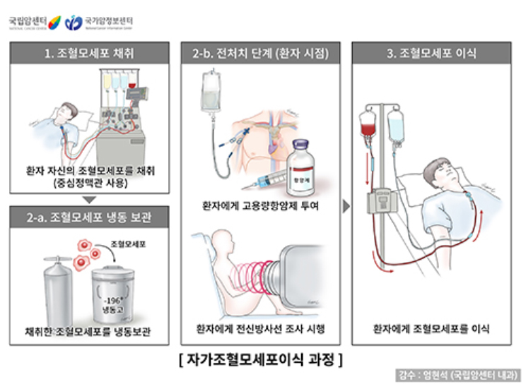 자가조혈모세포 이식