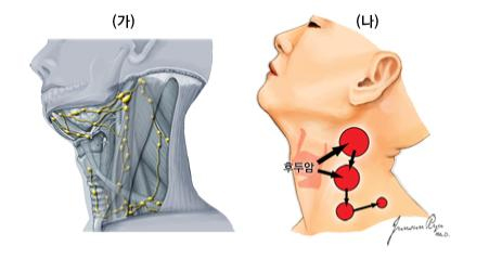 후두암의 경부전이