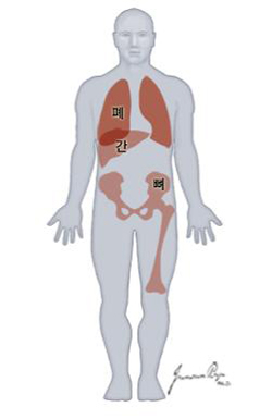 전이가 많이 되는 장기 (폐, 간, 뼈)