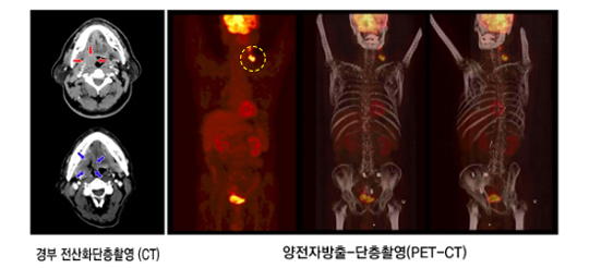 치료전 필요한 검사들 (경부 전산화단층촬영(CT), 양전자방출-단층촬영(PET-CT))