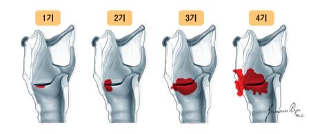 성문암의 원발부위 진행정도에 따른 병기 (1기, 2기, 3기, 4기)