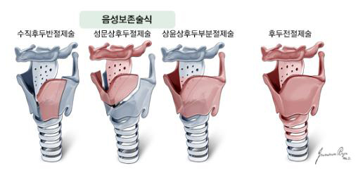 현재 널리 쓰이고 있는 후두암의 수술법들  음성보존술식 (수직후두반절제술, 성문상후두절제술, 상윤상후두부분절제술, 후두전절제술)