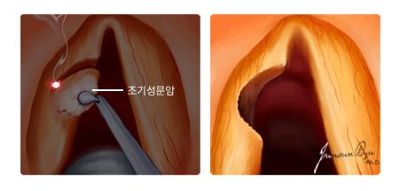 조기성문암 레이저 성대절제술 