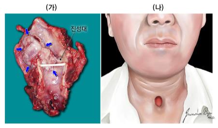 후두 전적출술  진성대, 후두의 위치