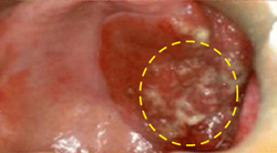 입천장에 발생한 편평상피세포암