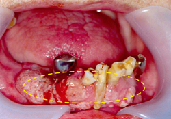 아래 잇몸에 발생한 구강암