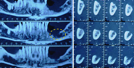 전산화단층촬영