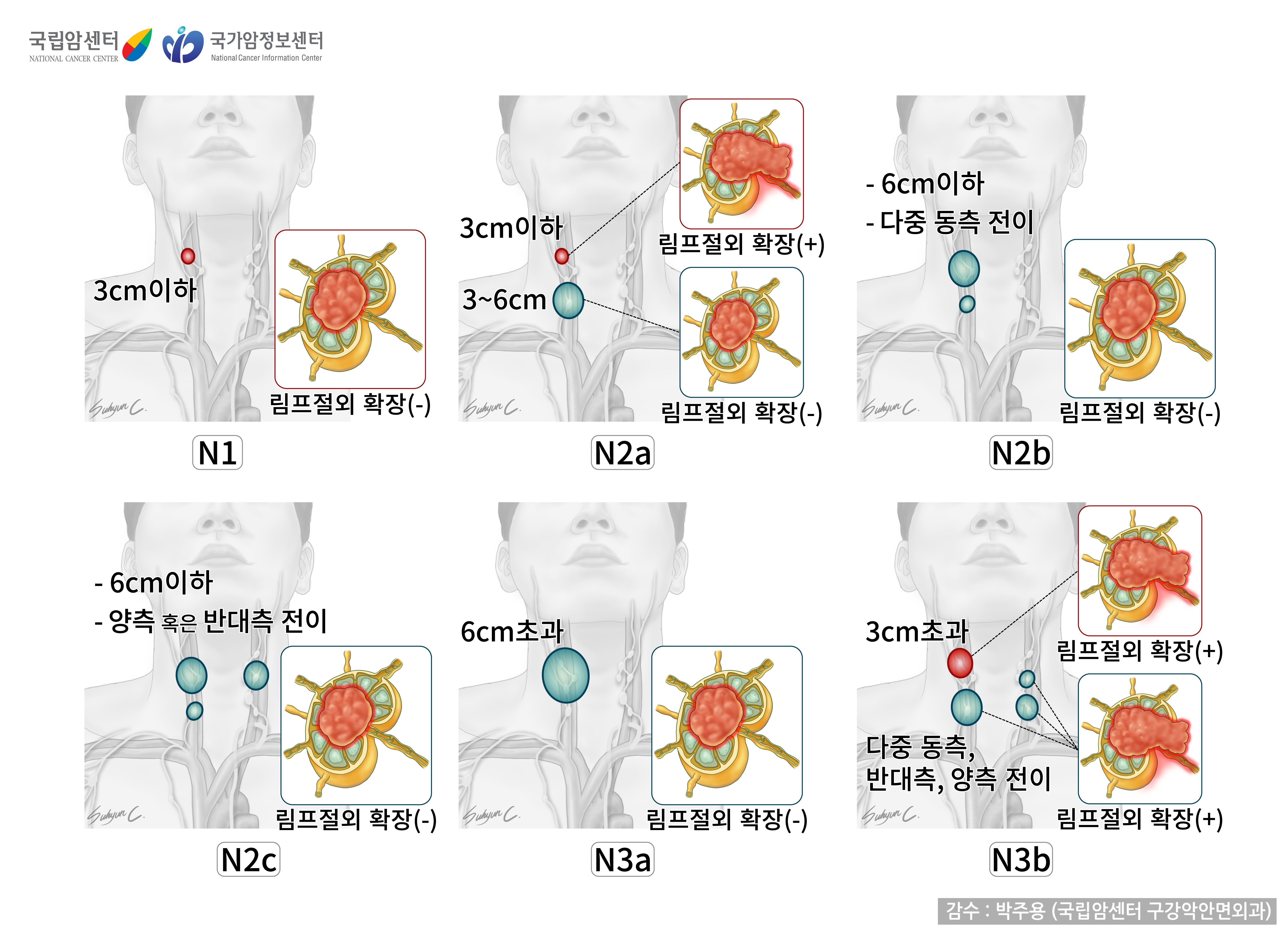 [구강암의 N(Node)병기]