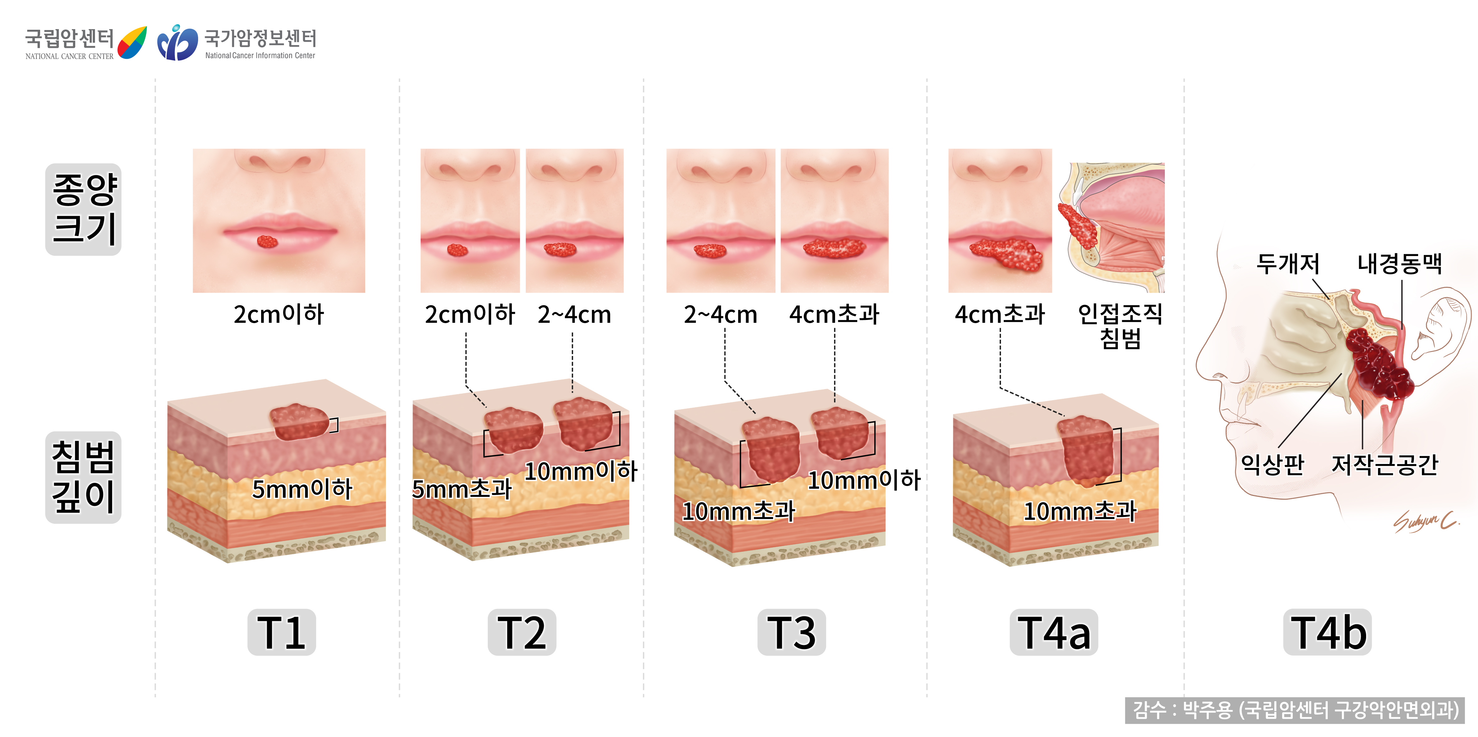 구순암의 T(Tumor)병기