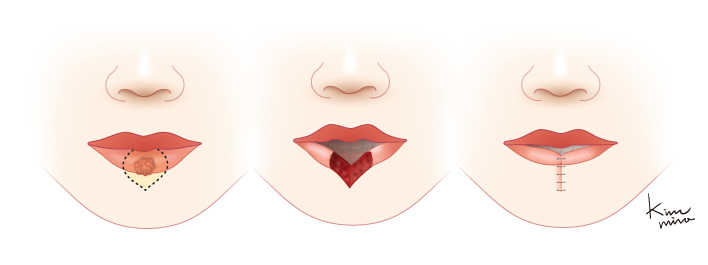 아랫입술에 발생한 병소의 크기가 크지 않은 경우 절제 후 직접 당겨서 봉합하는 모습