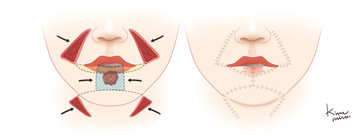 아랫입술에 사각형 모양의 큰 결손부가 있을 경우 사용하는 Fries의 방법에 의한 재건