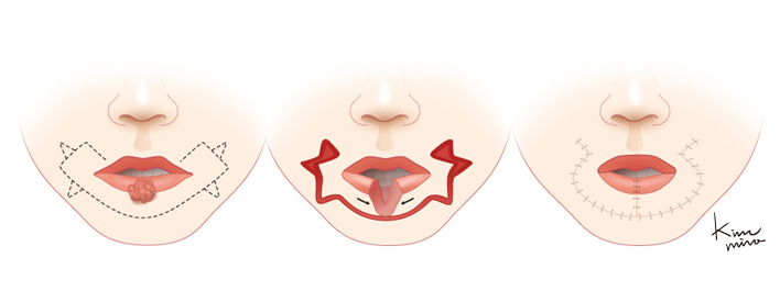 아랫입술에 광범위한 결손이 발생하였을 때 사용하는 fan-plastic 방법