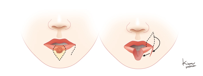 Estlnader 방법에 의한 재건술