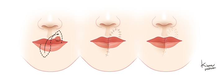 Abbe 방법에 의한 윗입술 재건 모습