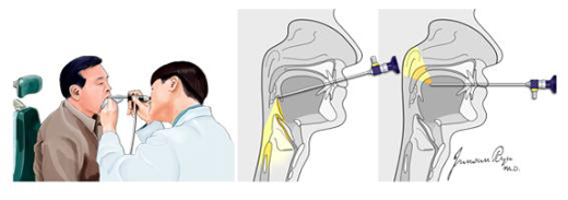 인두의 검사(경성 내시경)