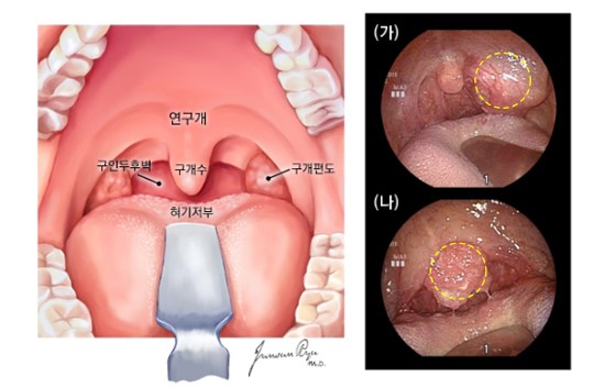 구인두의 정상소견과 구인두암