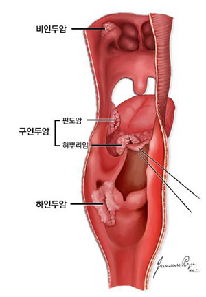 인두의 각 부위에서 발생하는 종양