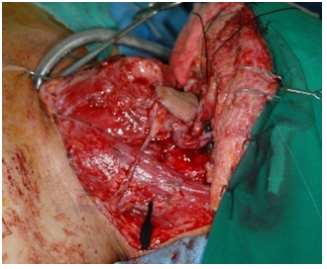 편도암 절제 후 유리피판을 이용한 결손부위의 재건