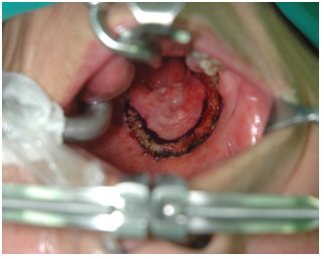 경구강 접근을 통한 편도암의 수술