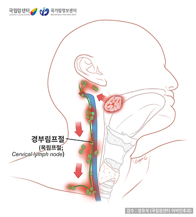 편도암의 경부림프절 전이 경로