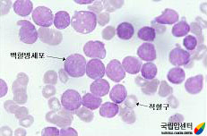 급성림프구성백혈병의 골수검사 소견